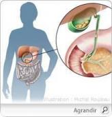 La lithiase biliaire
